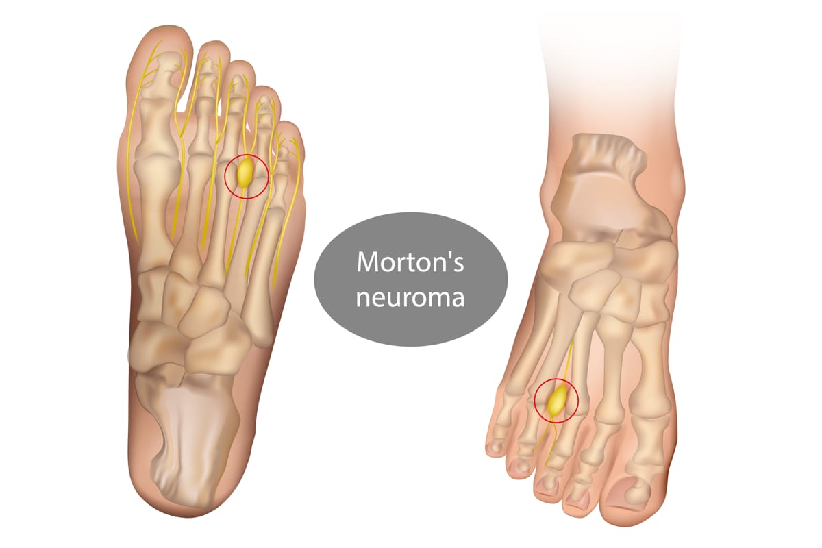 מורטונ'ס נוירומה Morton’s Neuroma