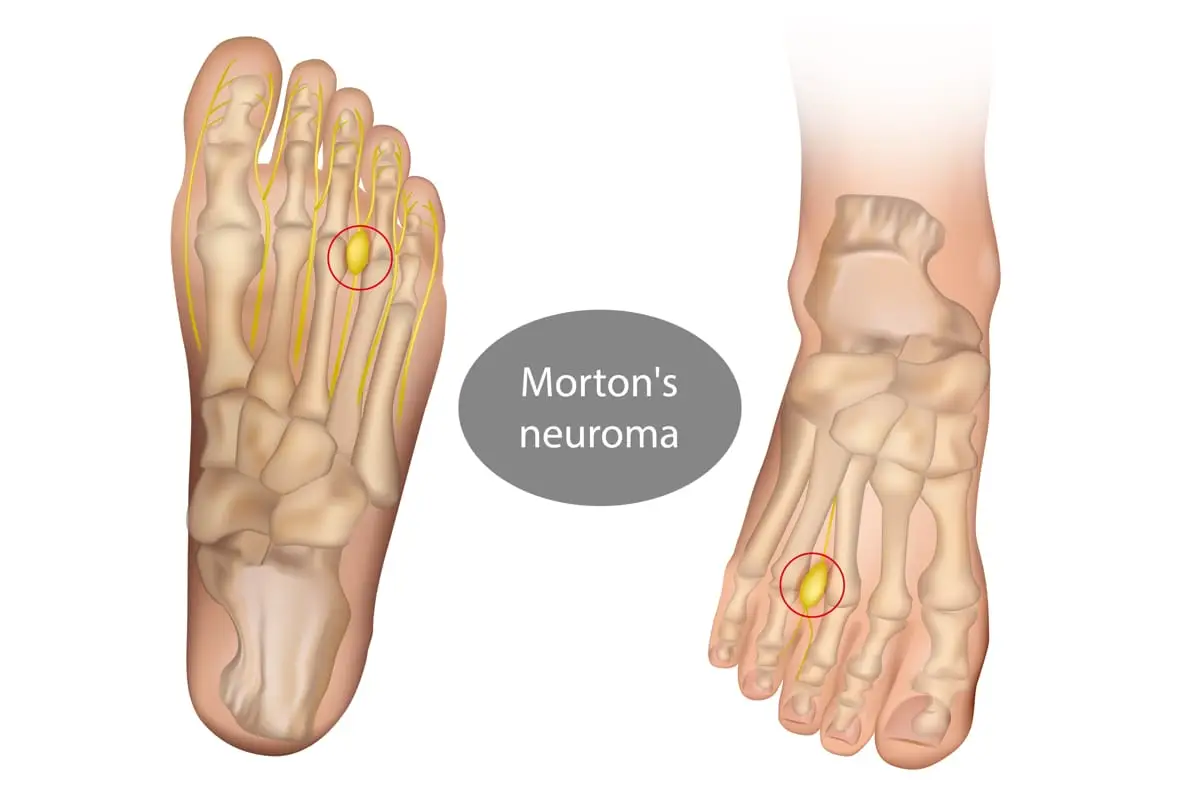 מורטונ'ס נוירומה Morton’s Neuroma